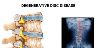Defying Degenerative Disc Disease: How Athletes Keep Competing at the Highest Level Degenerative Disc Disease in Athletes