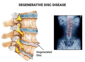 Defying Degenerative Disc Disease: How Athletes Keep Competing at the Highest Level Degenerative Disc Disease in Athletes